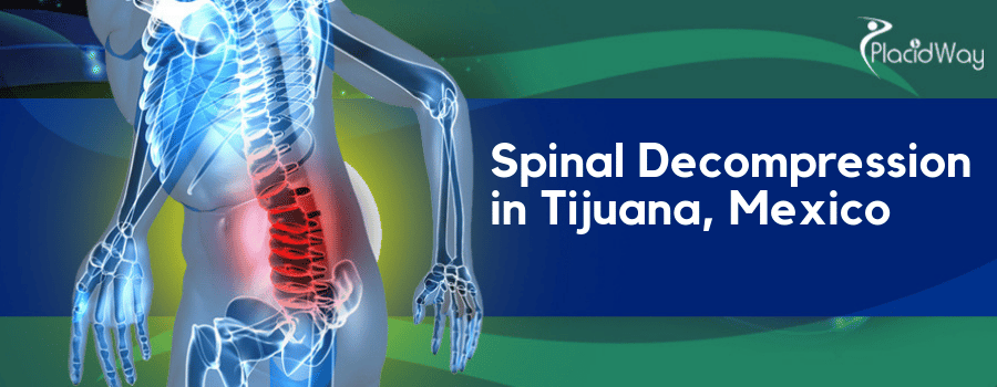 Spinal Decompression in Tijuana, Mexico